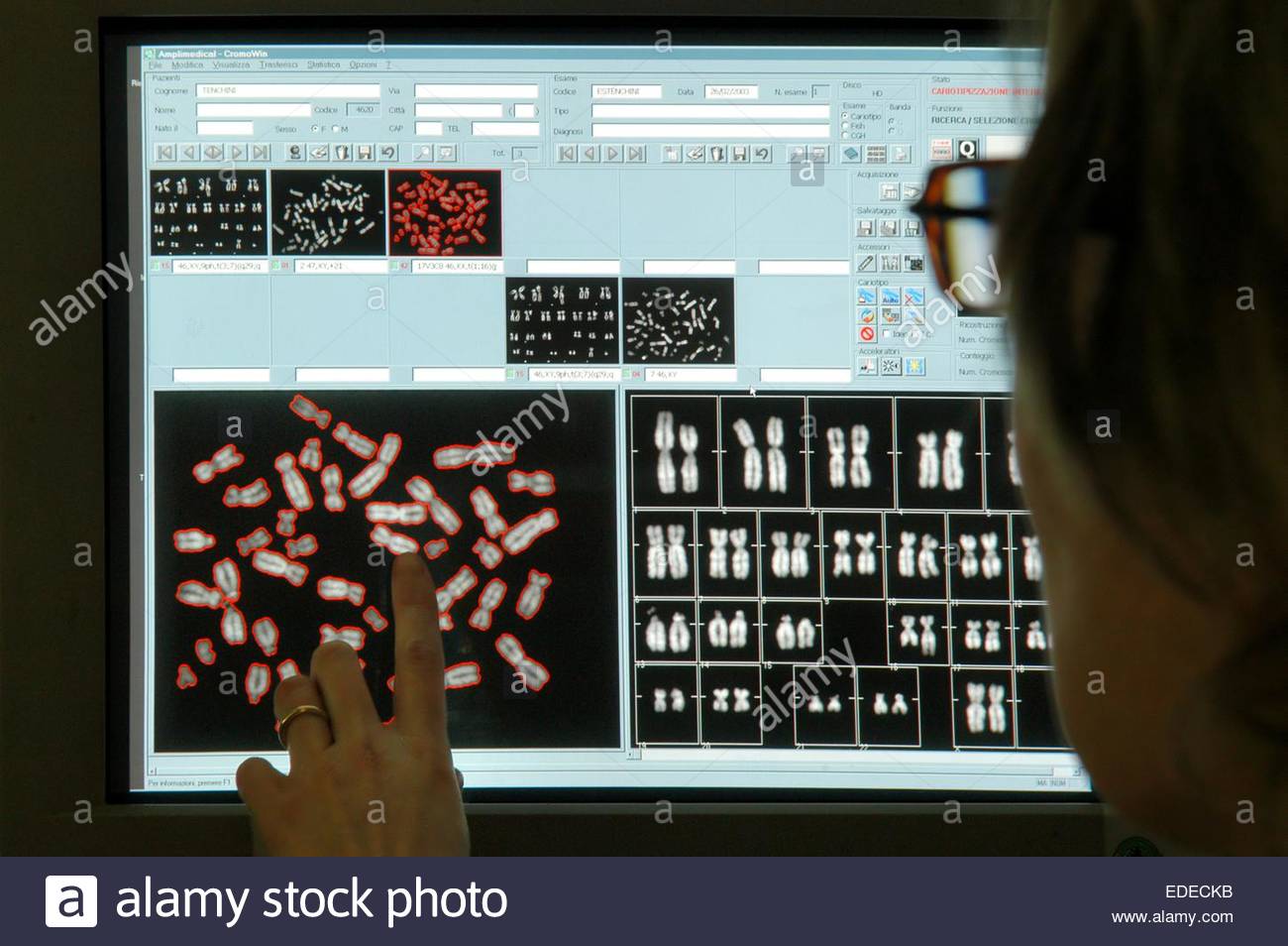 Des chercheurs mettent au point une IA capable de détecter des maladies génétiques rares En analysant les traits de visage des patients